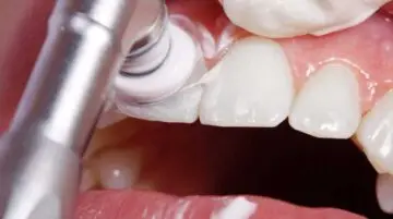 Zähne werden vom Zahnarzt poliert